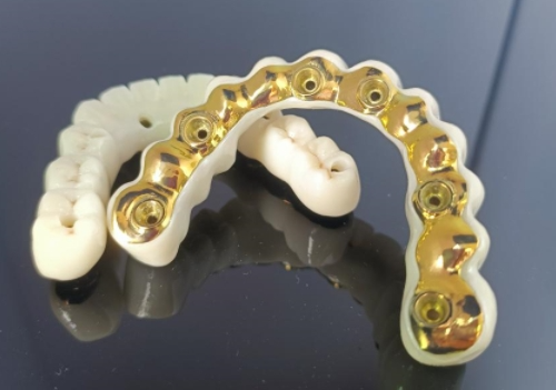 CAD/CAM titanový implantát + zirkonový můstek