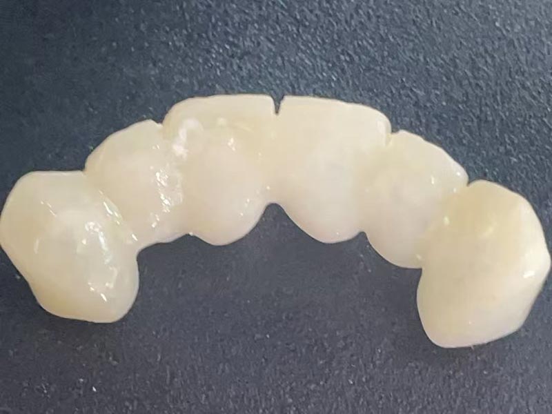 Co je to „dočasná koruna“? Proč ji potřebujete?