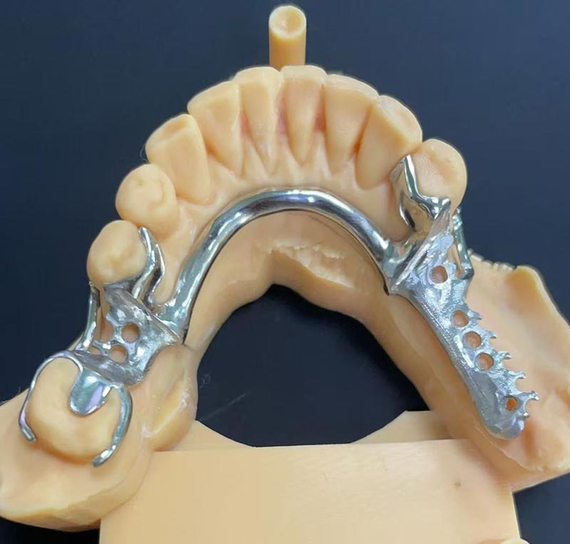 Výhody Cobalt-Chromium Framework (Co Cr Framework)