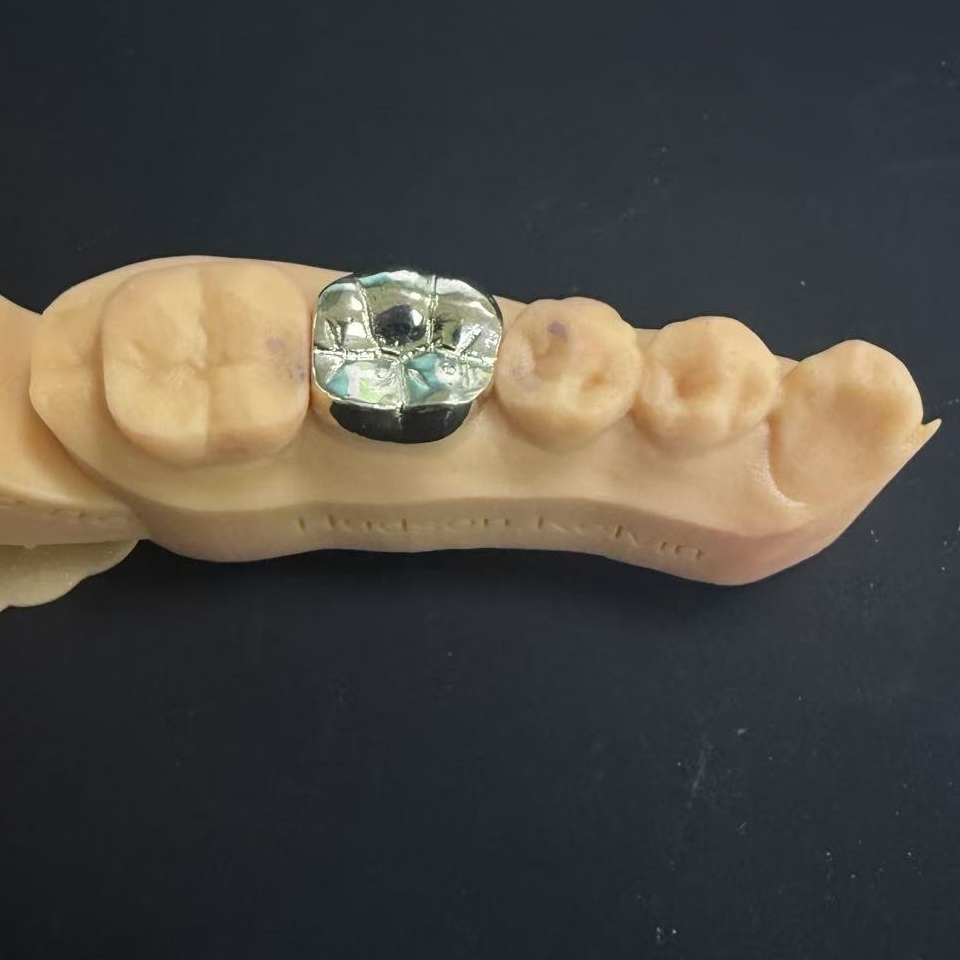 Zlaté koruny: Volba drahých kovů pro celoživotní obnovu zubů