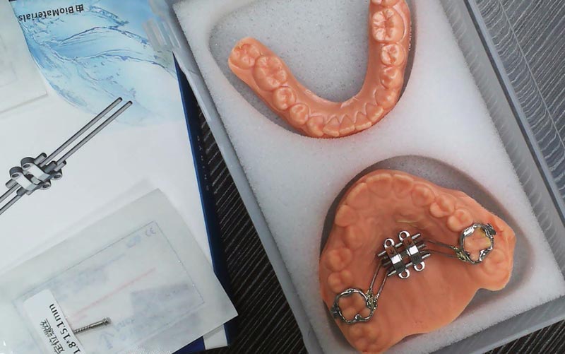 Porozumějte MSE Skeletal Expansion s WM Dental Lab