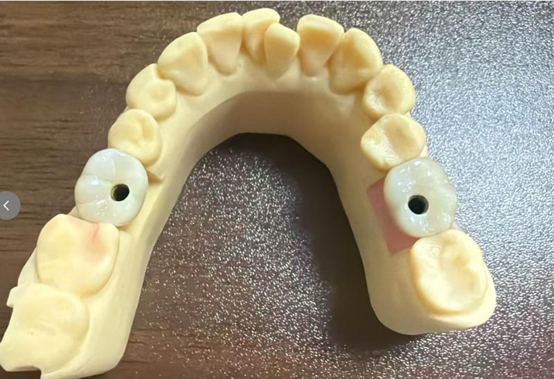 Proč je implantace předního zubu obtížnější než implantace zadního zubu?
