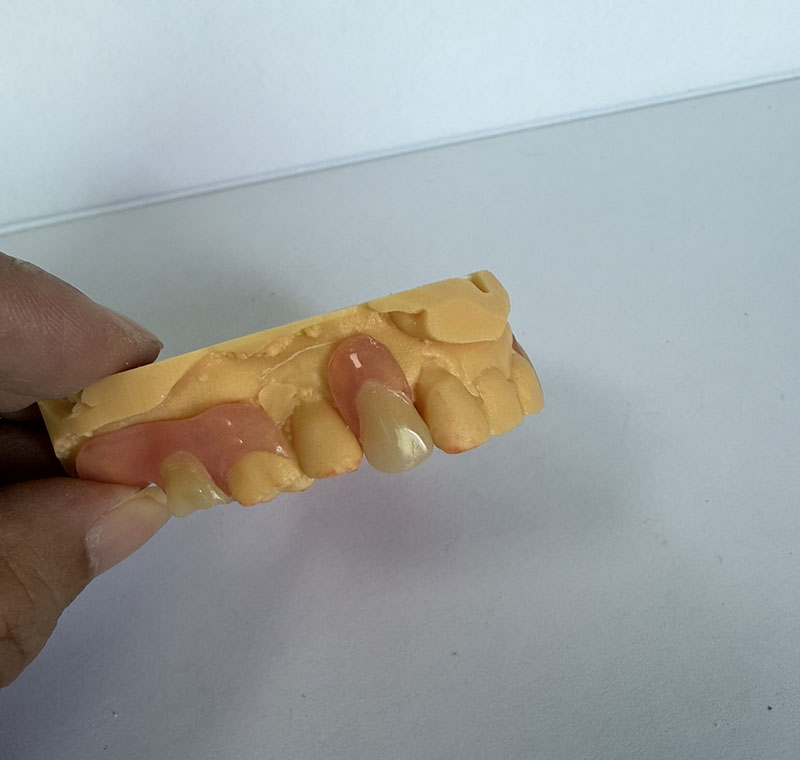 Valplast Partials ve společnosti WM Dental Lab