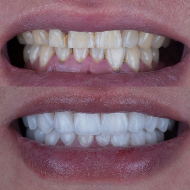 Emax Layered Veneers Esthetic China Dental Lab práce